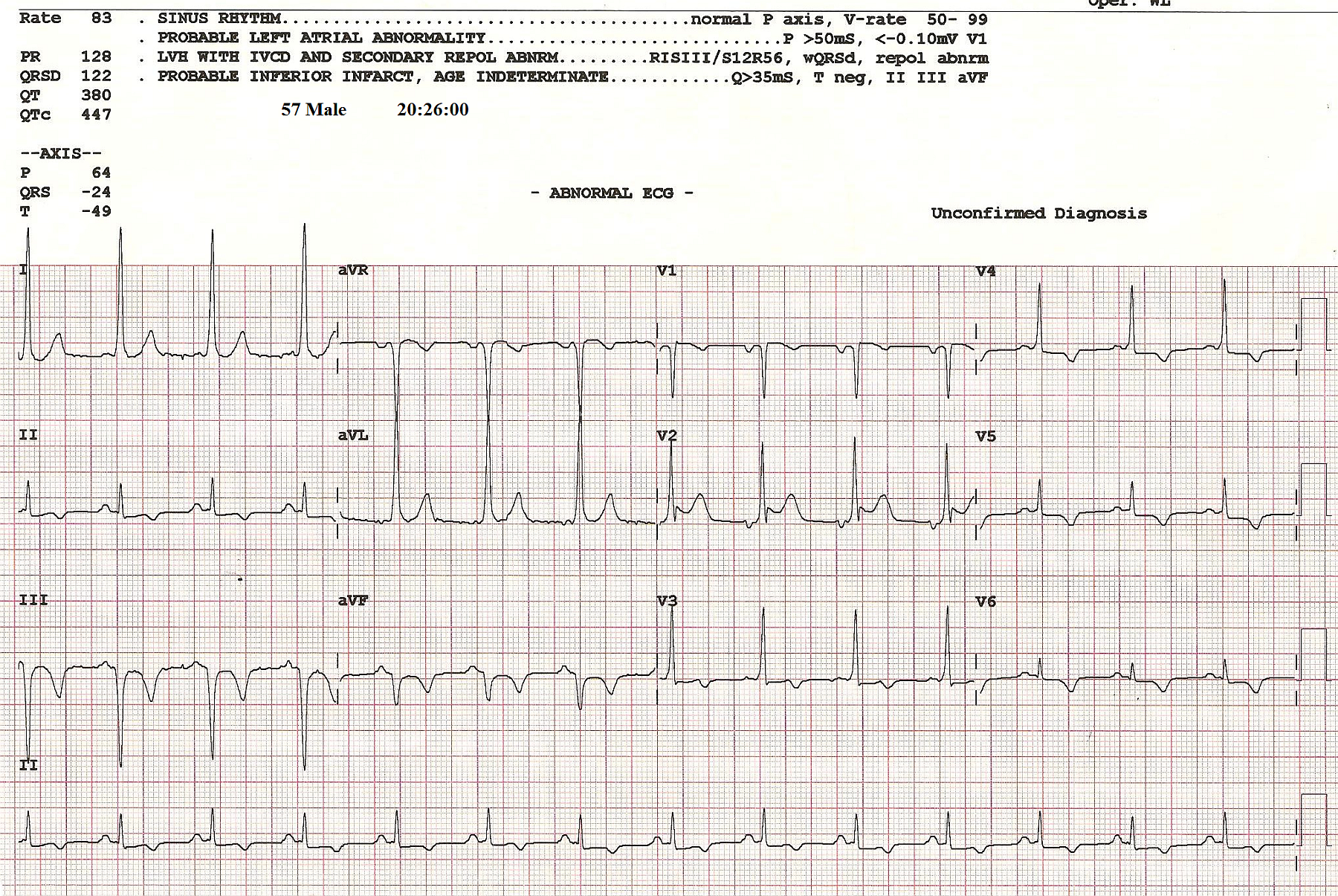 Wpw After Cardioversion From Wide Complex Tachycardia Ecg Guru Instructor Resources